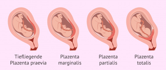 Die Placenta praevia: Ursachen, Diagnose und Geburt