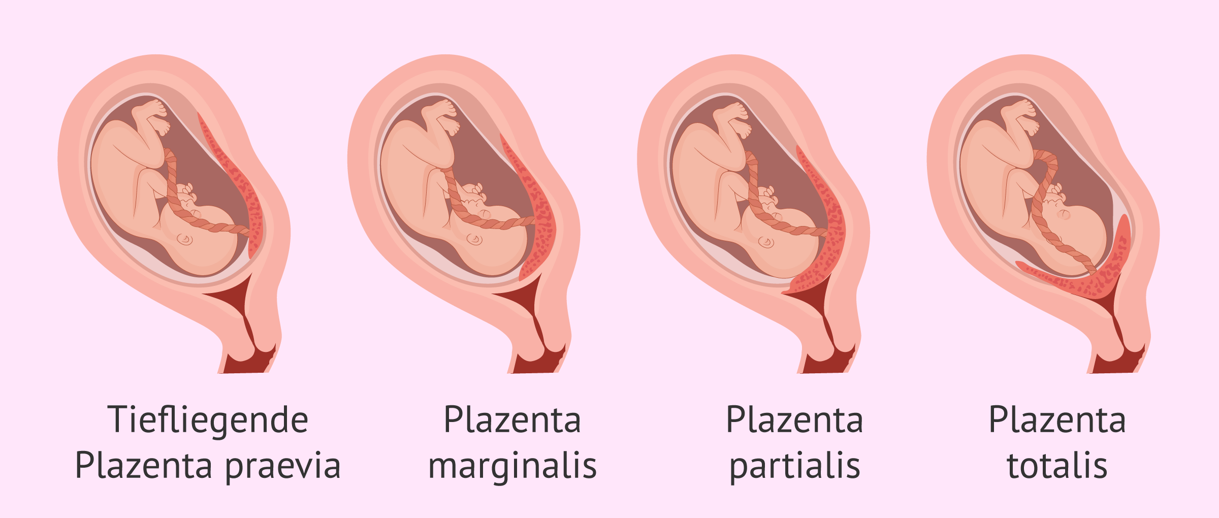Einteilung bei Placenta praevia