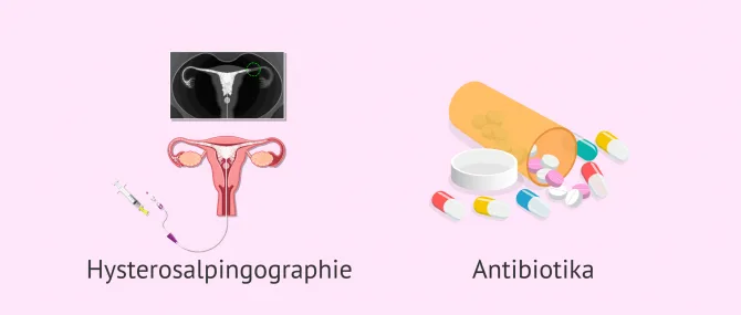 Imagen: Diagnose und Behandlung bei Salpingitis