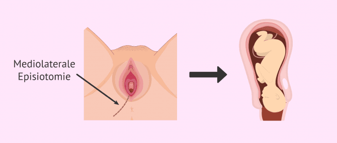 Imagen: Dammschnitt um die Geburt zu erleichtern