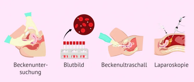 Imagen: Diagnose Beckenentzündung PID