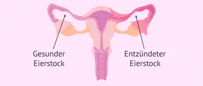 Imagen: Entzündete Eileiter (Salpingitis)
