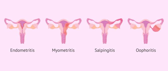 Imagen: Arten von entzündlichen Beckenerkrankungen (EIP)