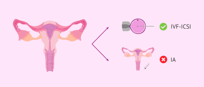 Imagen: Schwangerschaft bei Salpingitis