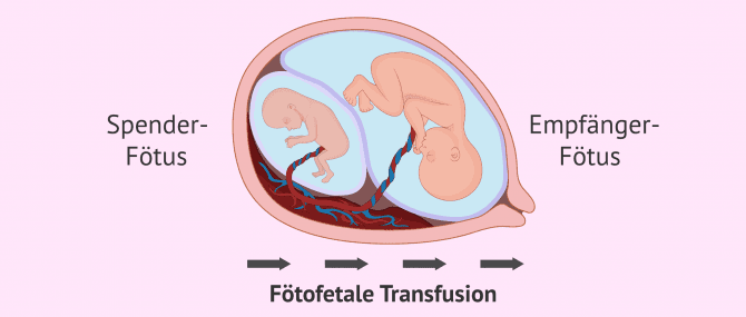 Imagen: Fötofetals Transfusionssyndrom
