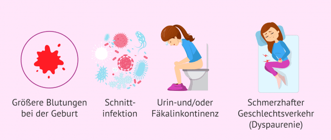 Imagen: Komplikationen Dammschnitt
