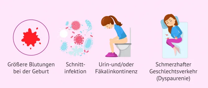 Imagen: Komplikationen Dammschnitt
