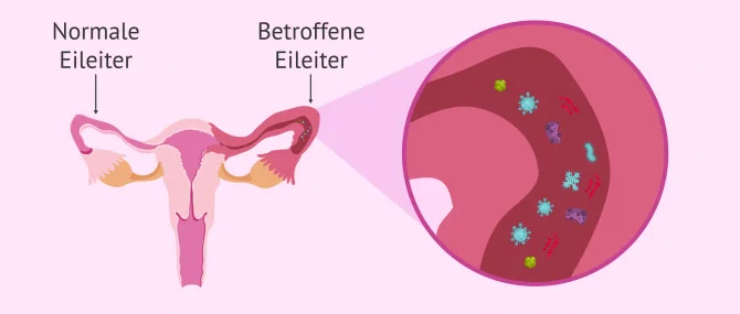 Imagen: Einseitige Salpingitis