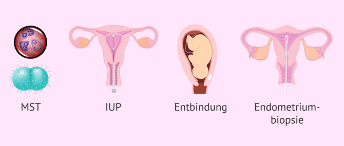 Imagen: Hauptursachen der Salpingitis