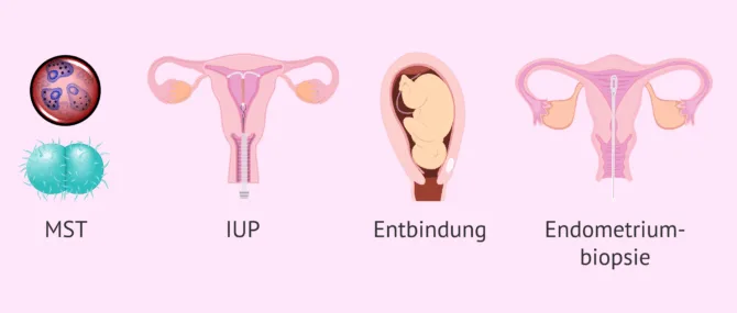 Imagen: Hauptursachen der Salpingitis