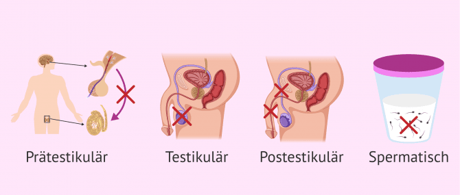 Imagen: Hauptfaktoren die bei männlicher Infertilität betroffen sind