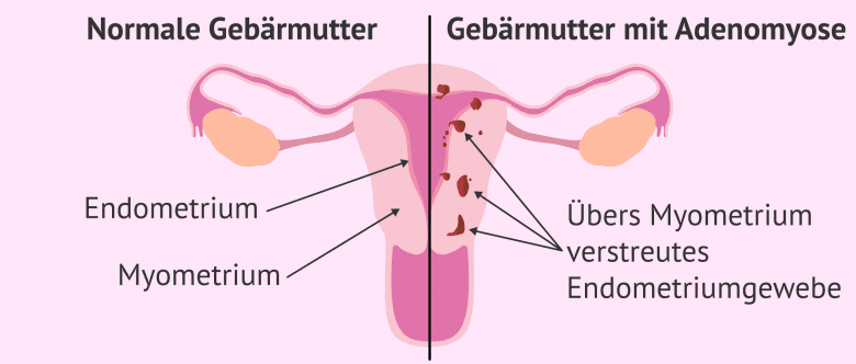 Was Ist Schlimmer Endometriose Oder Adenomyose www.invitra.de