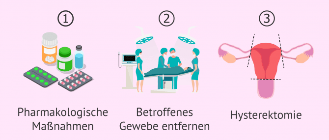 Imagen: Behandlung Adenomyose
