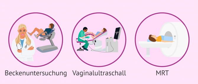 Imagen: Methoden zur Diagnostizierung von Adenomyose