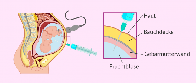 Imagen: Wie läuft eine Fruchtwasseruntersuchung ab?