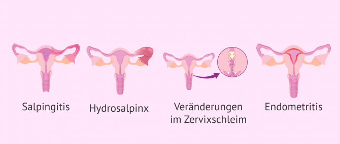 Imagen: Wie sich Geschlechtskrankheiten in der weiblichen Fruchtbarkeit bemerkbar machen