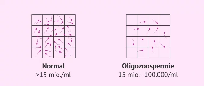 Imagen: Normale Probe und Probe mit Oligozoospermie