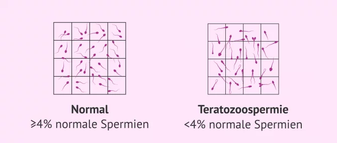 Imagen: Männliche Sterilität aufgrund von Teratozoospermie