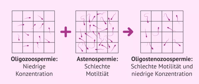 Imagen: Samenstörung: Oligoasthenozoospermie