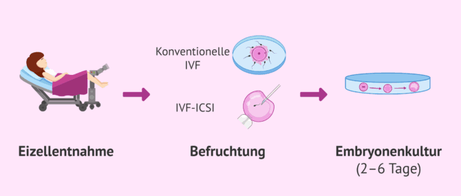 Imagen: Ovarialpunktion und Tag 0 der Embryonalentwicklung