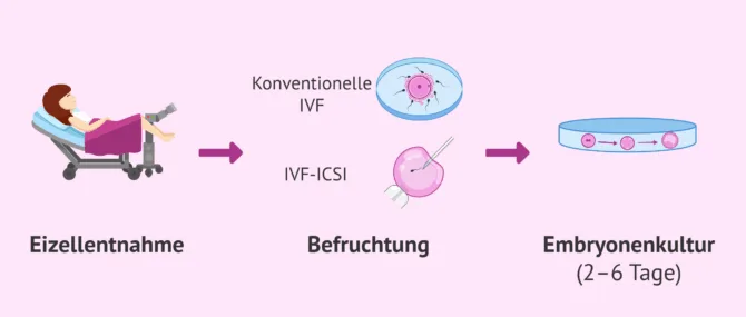 Imagen: Ovarialpunktion und Tag 0 der Embryonalentwicklung