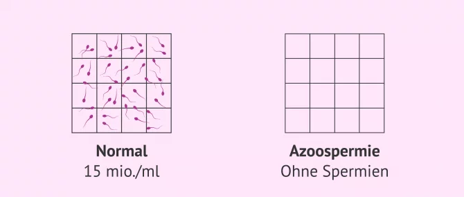 Imagen: Normale Spermaprobe und Samenprobe mit Azoospermie