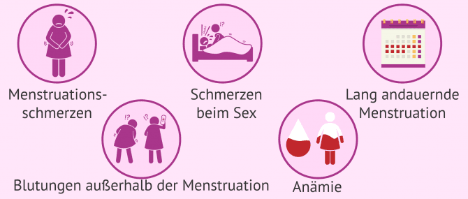 Imagen: Symptome bei Adenomyose