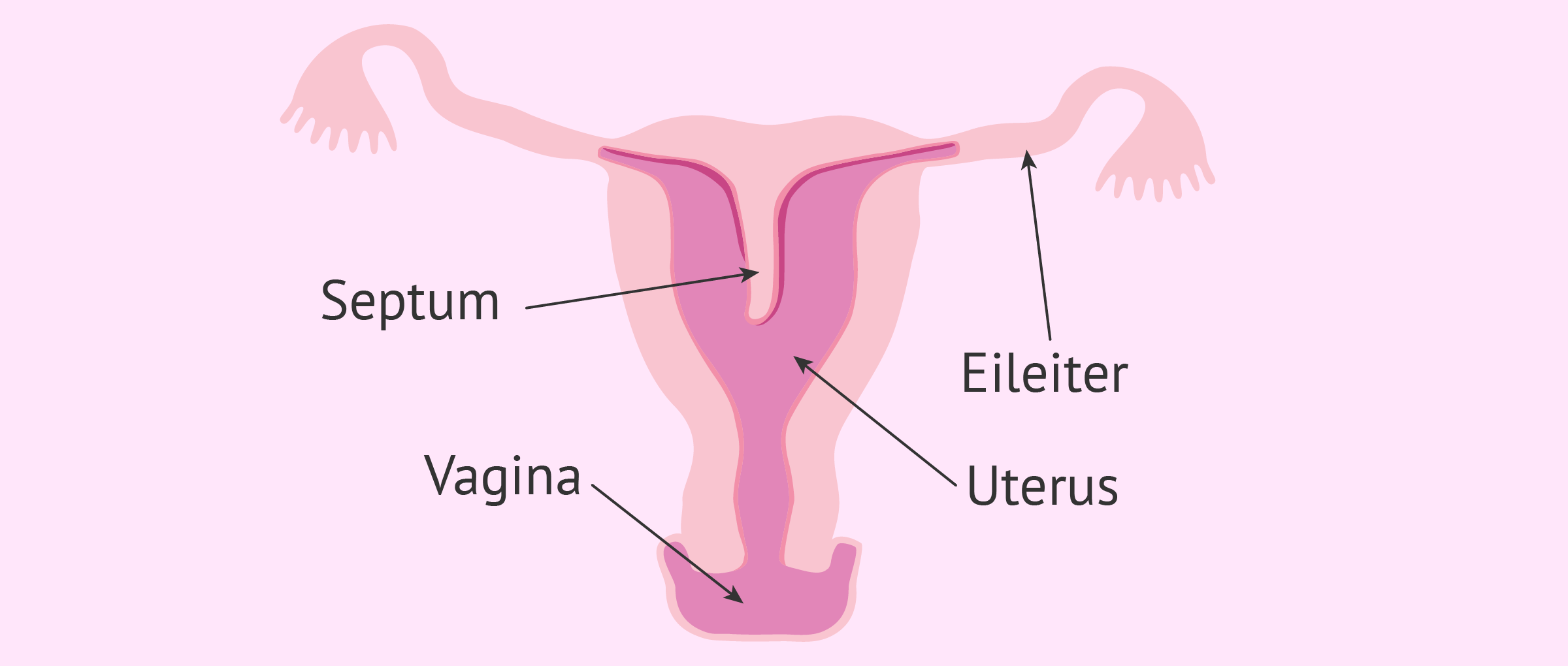 Uterus mit Septum