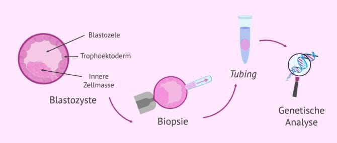 Imagen: Ablauf der Embryobiopsie an Tag 5