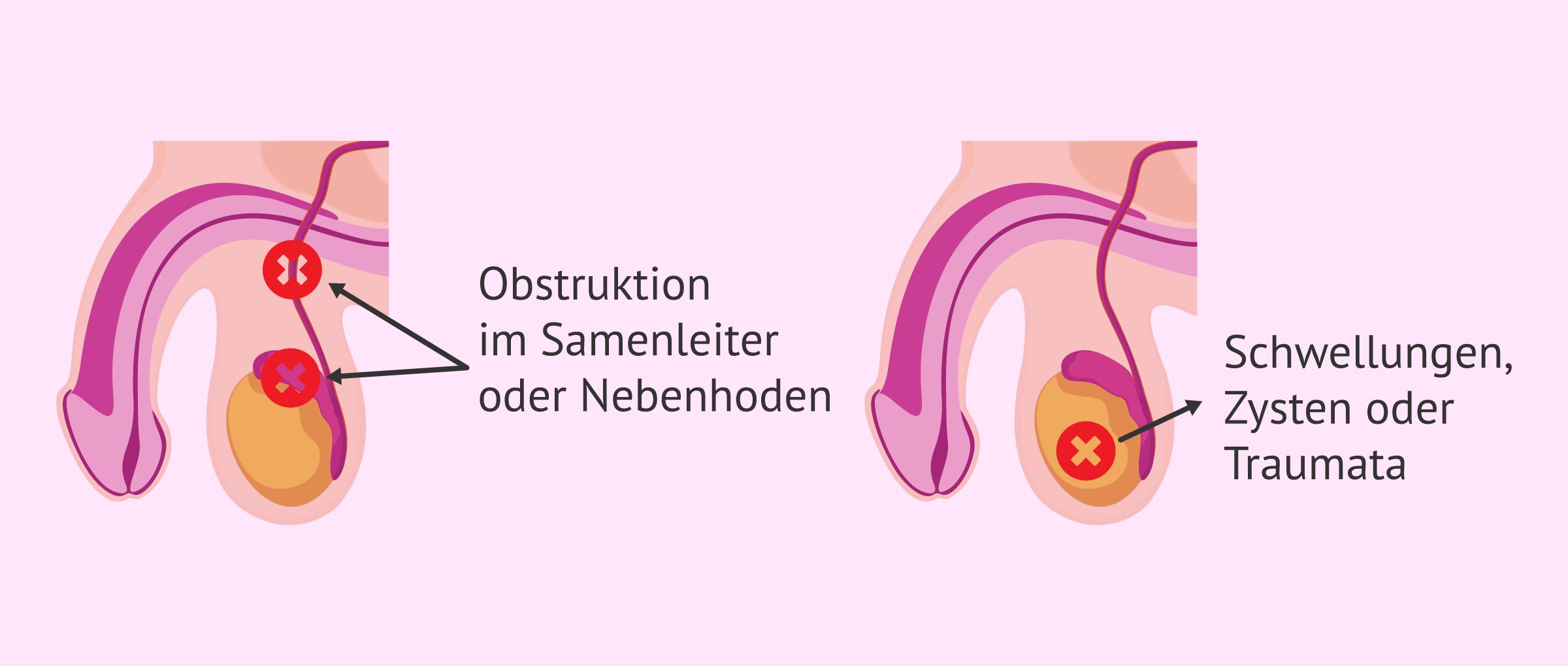 Ursachen der obstruktiven Azoospermie