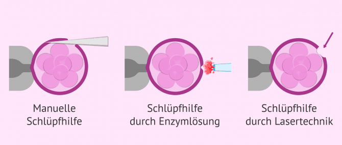 Imagen: Methoden im Assisted Hatching