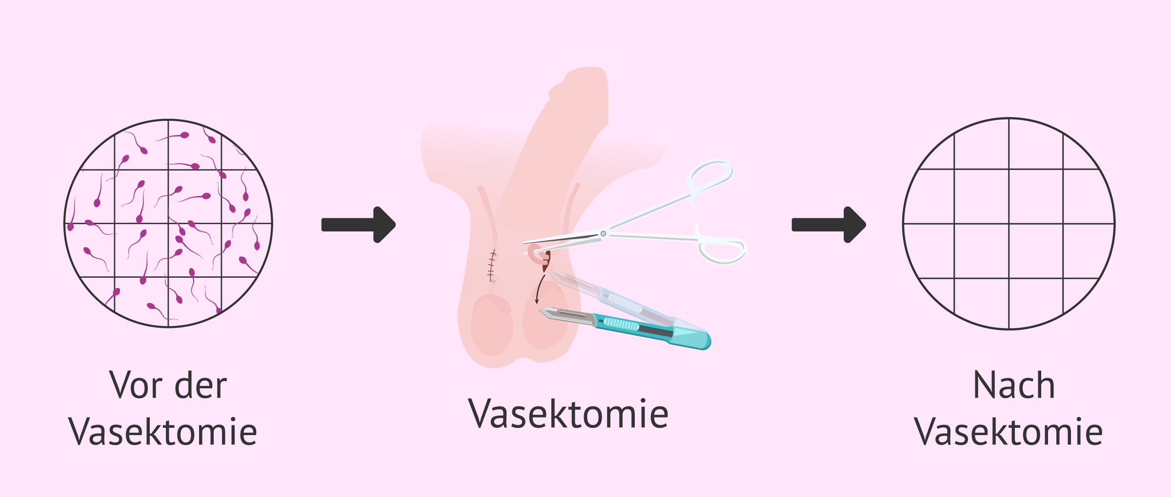 Fehlen von Spermien nach Vasektomie