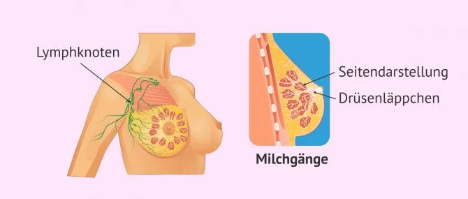 Brustkrebs: Symptome, Diagnostik und Behandlung