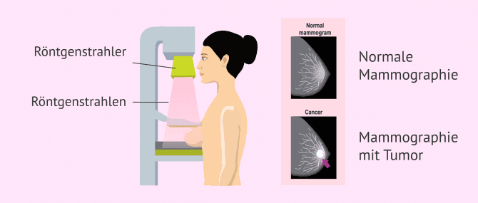 Imagen: Mammographie-Screening