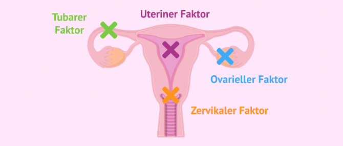 Imagen: Ursprung der weiblichen Sterilität