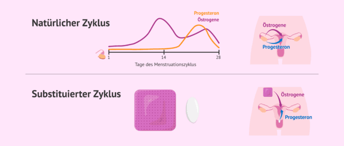 Imagen: Arten der Endometriumvorbereitung für den Transfer von gefrorenen Embryone