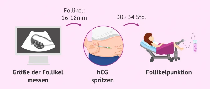 Die Follikelpunktion: Entnahme der Eizellen in einer IVF
