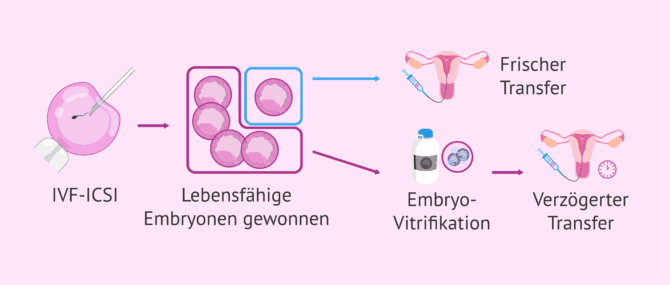 Imagen: Perinatale Ergebnisse nach frischem oder verzögertem Transfer