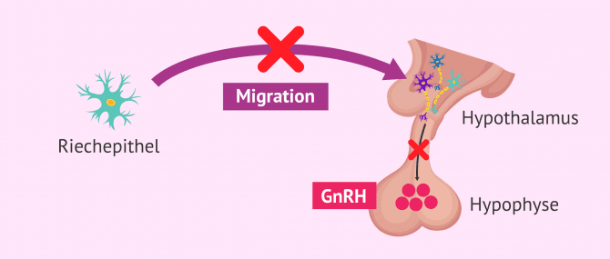 Imagen: GnRH-Mangel beim Kallmann-Syndrom