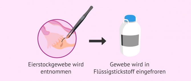 Imagen: Methode zum Einfrieren von Ovargewebe