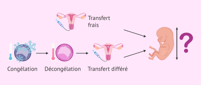 Imagen: Frischetransfer oder verzögerter Transfer und fetales Wachstum