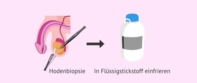 Imagen: Wie Hodengewebe eingefroren wird