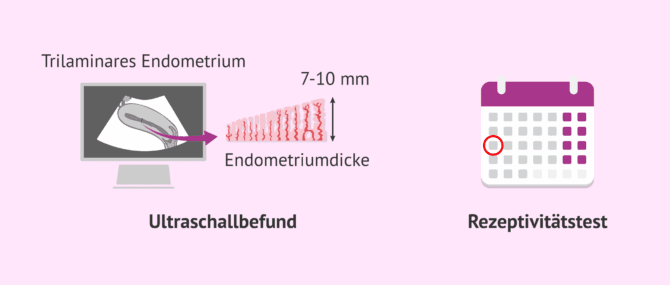 Imagen: Ultraschalluntersuchung des Endometriums und das Einnistungsfenster
