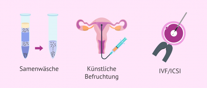 Imagen: Kinderwunschbehandlung bei HIV