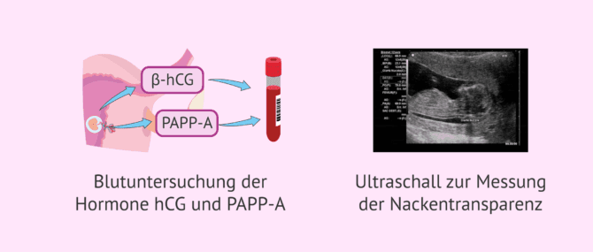 Imagen: Medizinische Untersuchungen in der 9. Schwangerschaftswoche