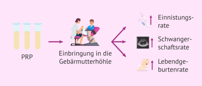 Imagen: Ist thrombozytenreiches Plasma in der assistierten Reproduktion wirksam?