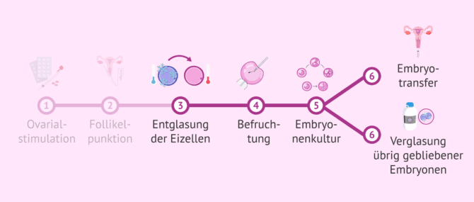 Imagen: Schritt für Schritt zur IVF mit vitrifizierten Eizellen