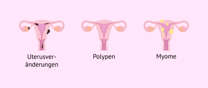 Imagen: Einige endometriale Ursachen, die die Einnistung des Embryos beeinträchtigen