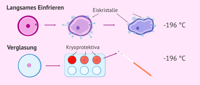 Imagen: Langsames Einfrieren und Vitrifikation von Eizellen