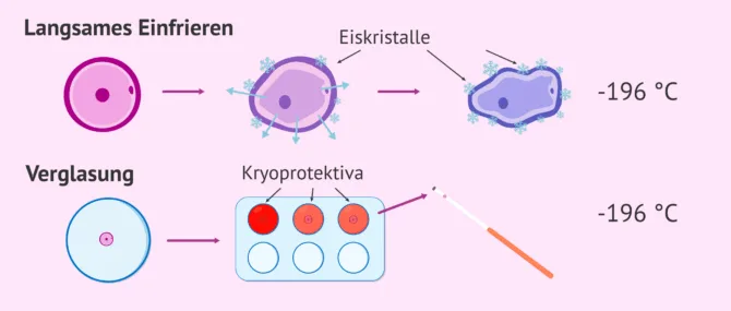 Was ist IVF mit vitrifizierten Eizellen und wie sind die Ergebnisse?